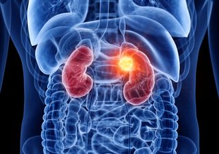 Researchers unlock new biomarkers for rare renal cell carcinoma detection and diagnosis