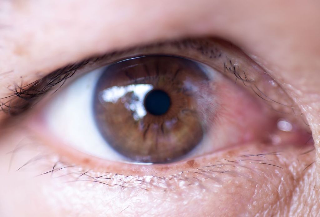 Carnosidad en los ojos, ¡cuidado! puede crecer y afectar tu vision