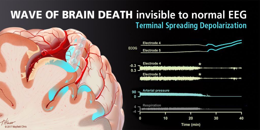 “tsunami” Cerebral Y Muerte “tsunami” Cerebral Y Muerte