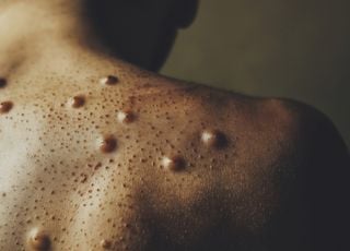 Un cas de variole du singe MPOX détecté en Allemagne : doit-on craindre sa propagation en France ?