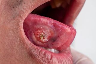 ¿Más que una limpieza? Por qué una simple visita al dentista es clave para detectar el cáncer de boca a tiempo