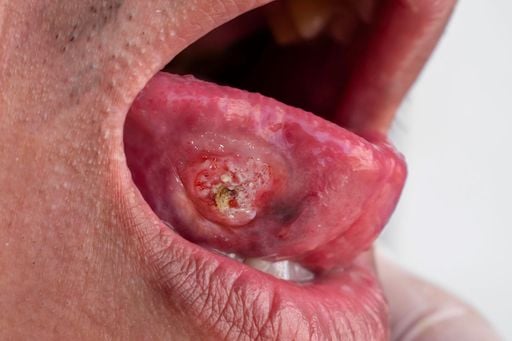 Una visita al dentista te puede salvar la vida, el c&aacute;ncer de boca