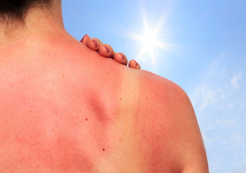 sonnenbrand, deutschland, muttertag sonnenbrand, deutschland, muttertag
