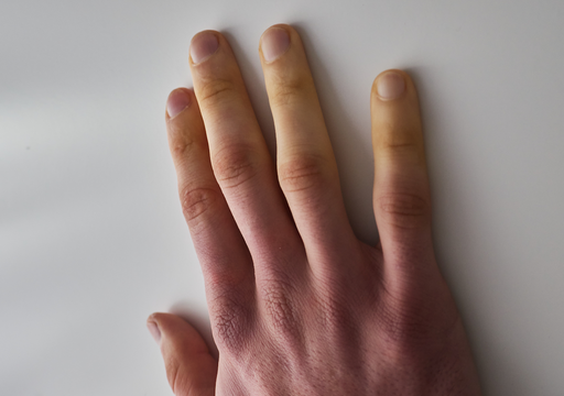 Warum Finger in der K&auml;lte ihre Farbe wechseln &ndash; so wirkt das Raynaud-Ph&auml;nomen im K&ouml;rper